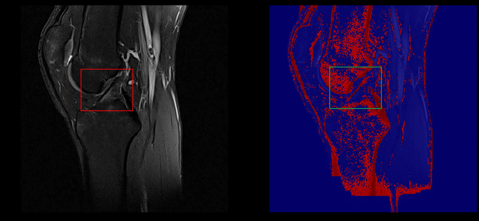 Segmentation Example (Healthy ACL)