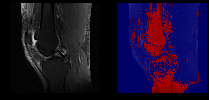 Segmentation Example (Unhealthy ACL)